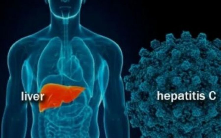 Ini Fase Penyakit Hepatitis Akut Berat Menurut Dokter Spesialis