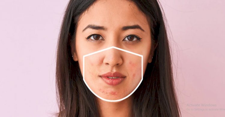 Cara Mengatasi Maskne, Jerawat Akibat Penggunaan Masker